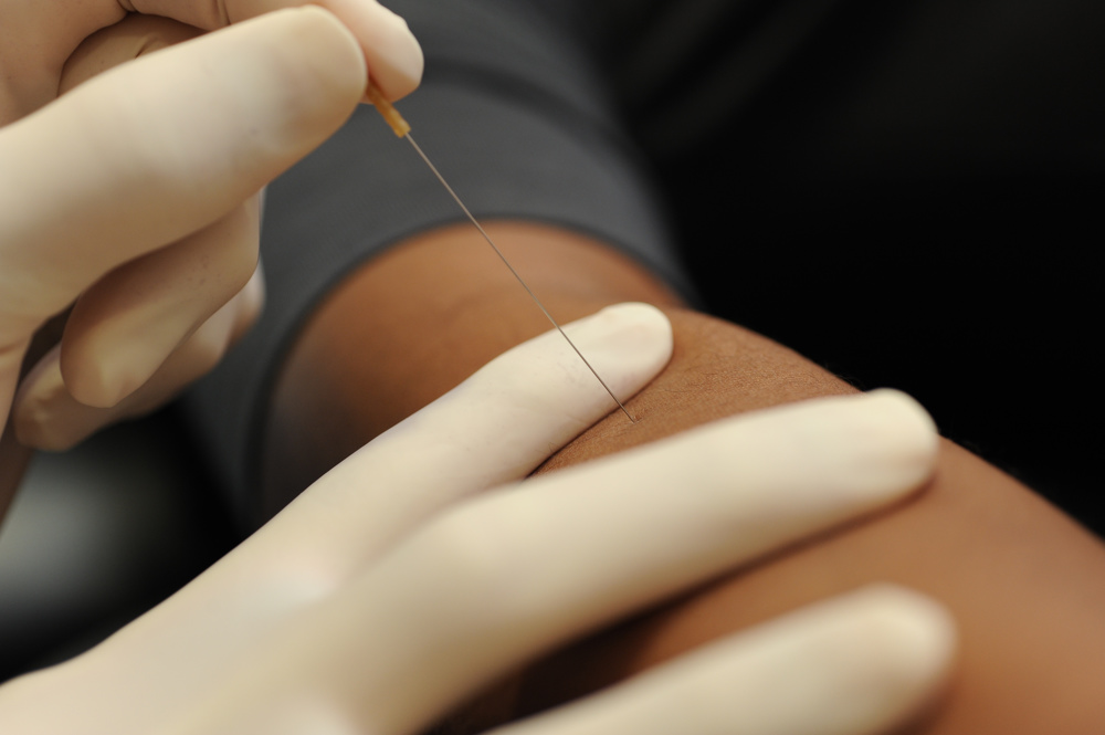 dry needling