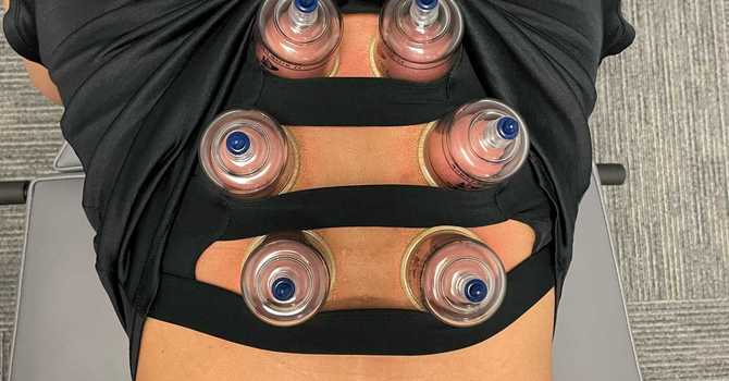 Cupping and Fascial Release
